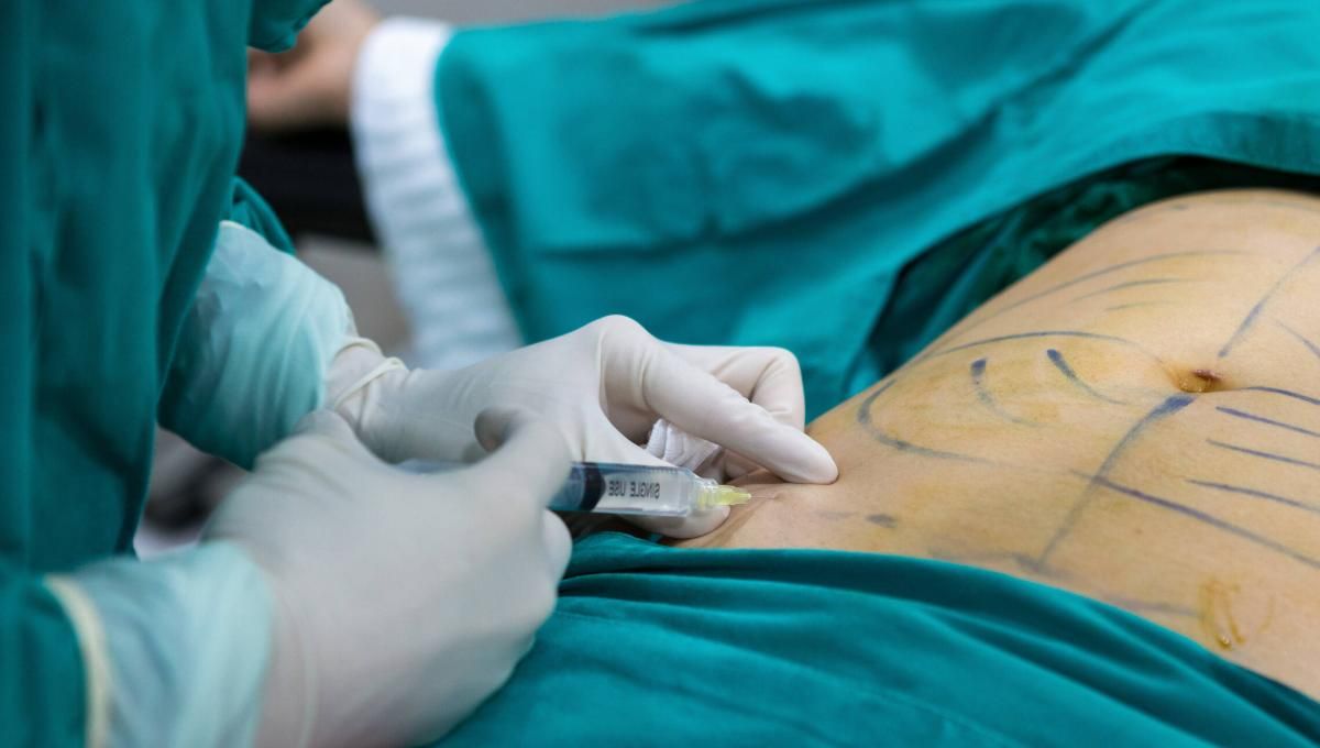 abdominoplastia en Asturias